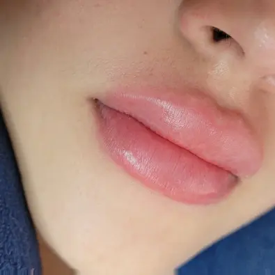 Aumento de Labios con Ácido Hialuronico — imagen 1