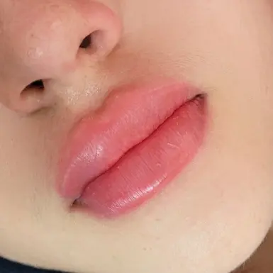 Aumento de Labios con Ácido Hialuronico — imagen 2