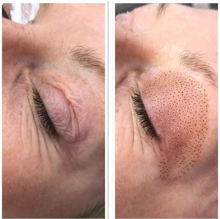 BLEFAROPLASTIA SIN CIRUGÍA's foto | Laiz's  Salon-Academy |  BizneCubano