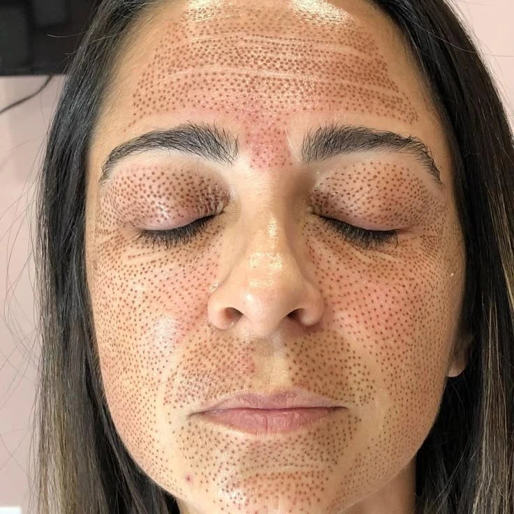 Fibroblast Facial Completo's foto | Laiz's  Salon-Academy |  BizneCubano