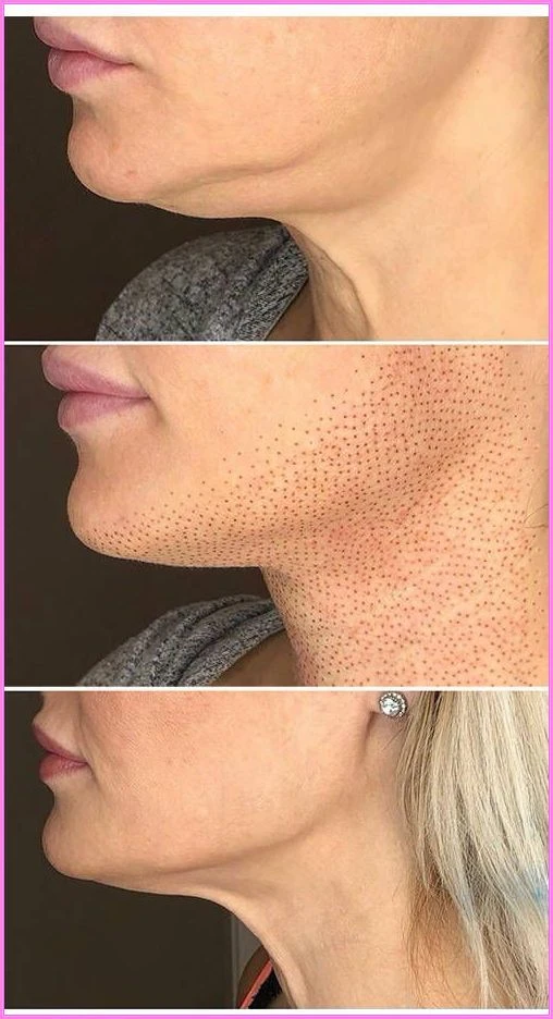 FIBROBLAST PAPADA's foto | Laiz's  Salon-Academy |  BizneCubano