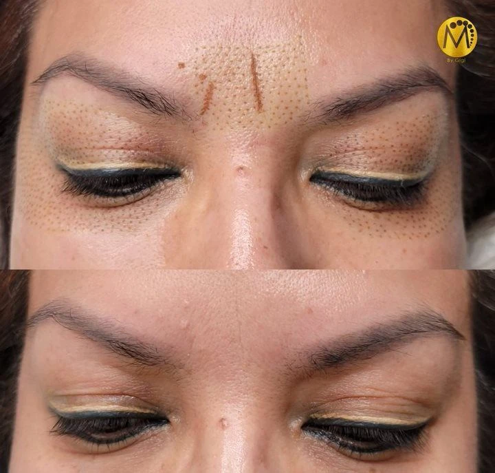 FIBROBLAST SOLO ENTRECEJO's foto | Laiz's  Salon-Academy |  BizneCubano