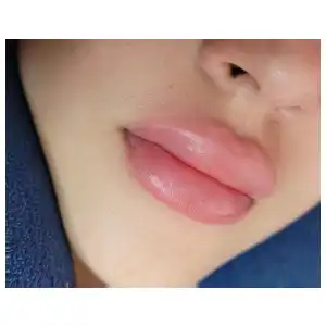 Aumento de Labios con Ácido Hialuronico miniatura 1