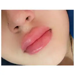 Aumento de Labios con Ácido Hialuronico miniatura 2